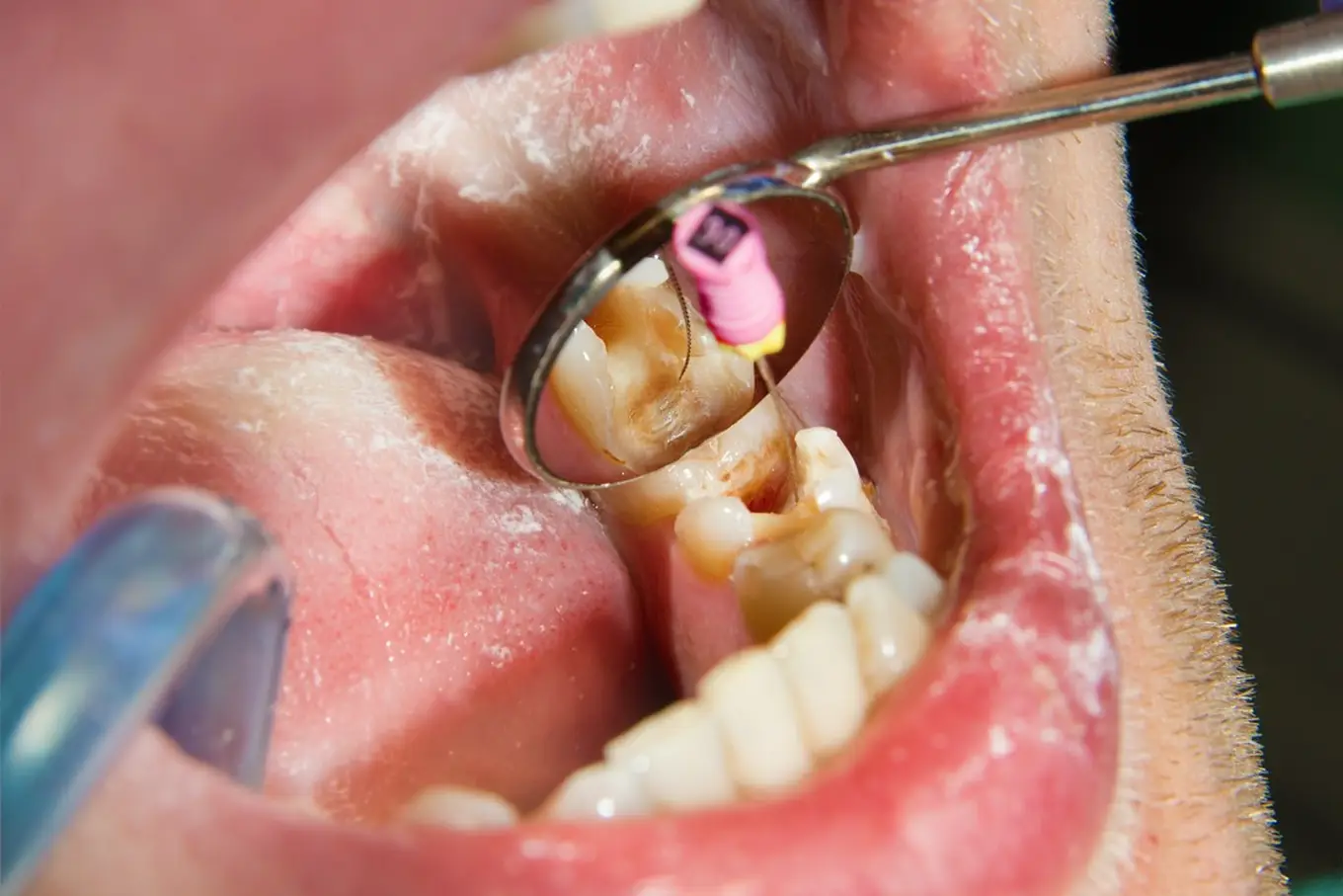 ząb leczony kanałowo
